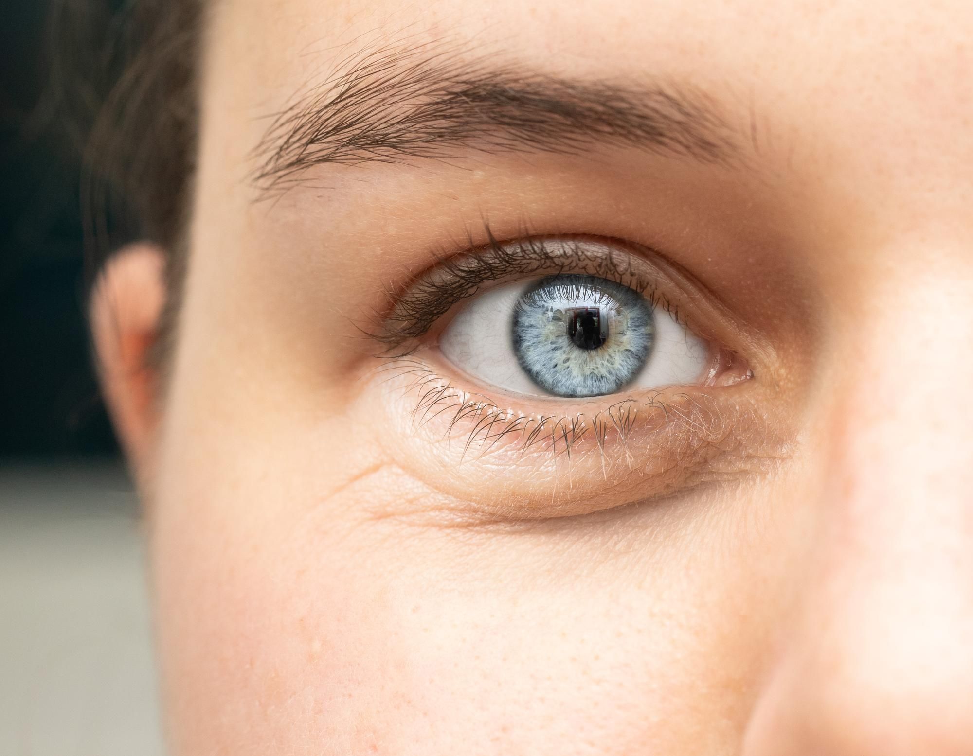 Plano detalle de ojos de mujer. Paciente para cirugía de párpados