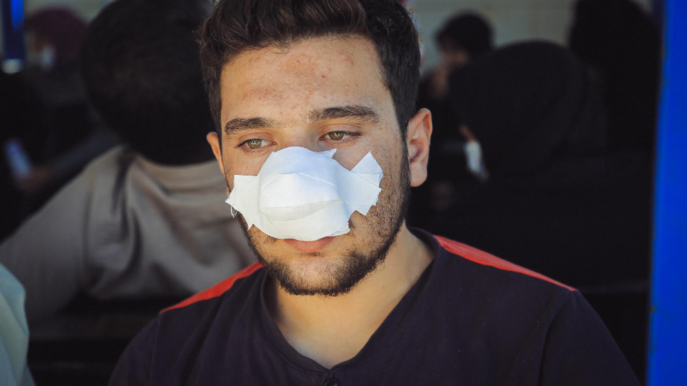 Como la rinoplastia ultrasónica puede ayudarte tras un traumatismo nasal