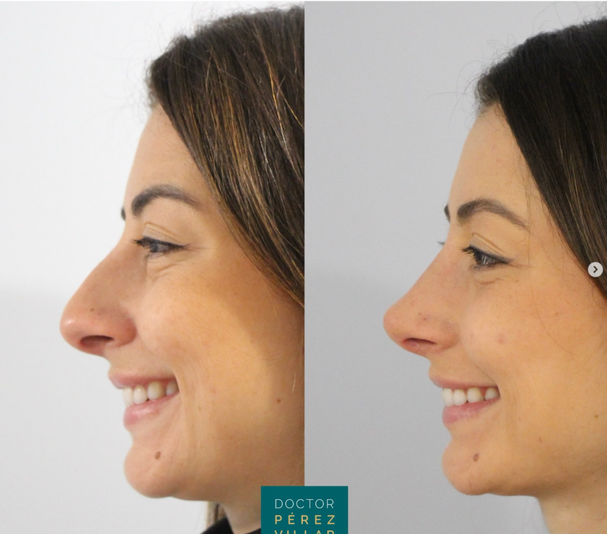 Evolución de la rinoplastia