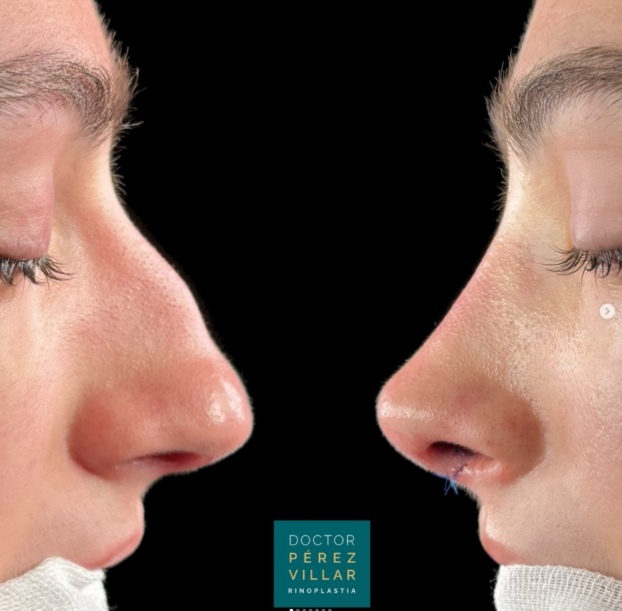 Dr. Pérez Villar explica como conseguir una nariz natural y funcional con rinoplastia ultrasónica.