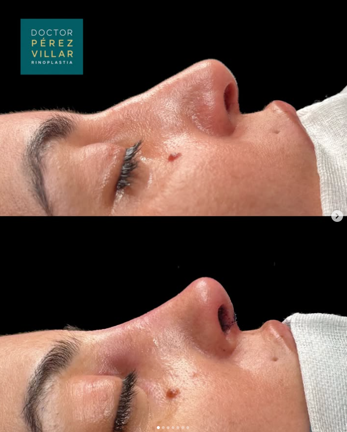 Antes y después rinoplastia ultrasónica, perfil femenino, Clínica Pérez Villar Santander