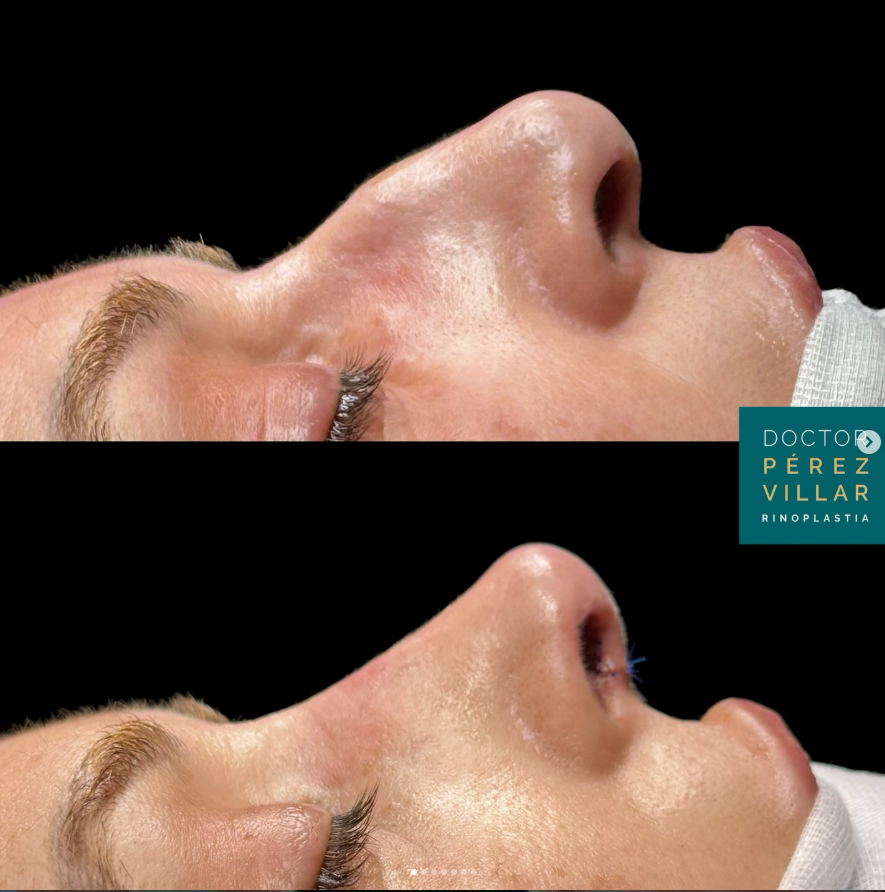 Antes y después rinoplastia ultrasónica, perfil masculino, Clínica Pérez Villar Santander