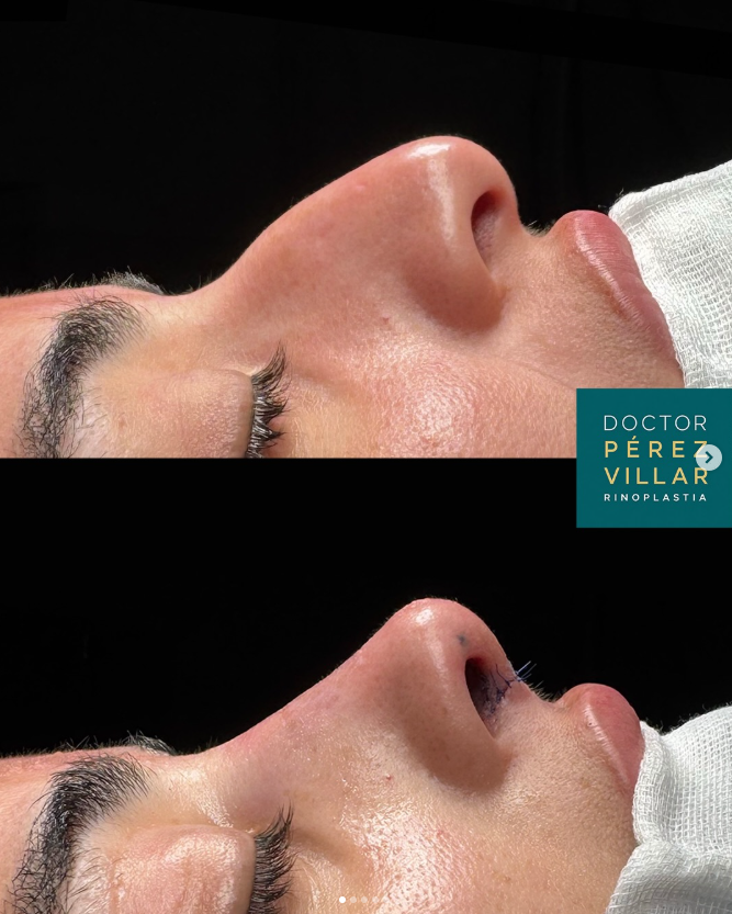 Antes y después rinoplastia ultrasónica, segundo caso masculino, Clínica Pérez Villar Santander